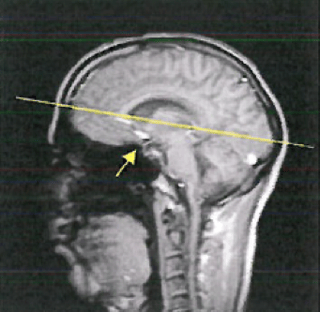 Hypopituitarism from head injury